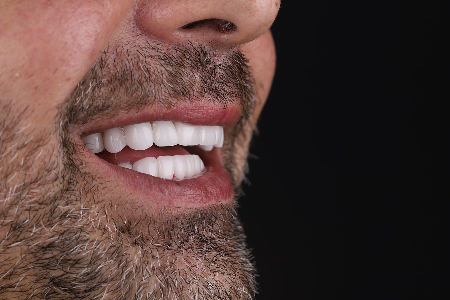 After image of a patient showcasing the successful dental implant transformation by Quadro Dental.