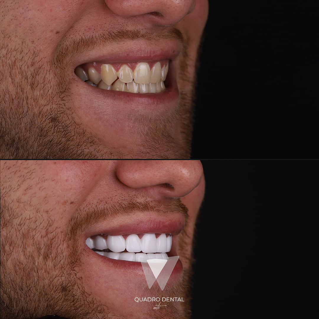 Quadro Dental patient before and after comprehensive dental treatment