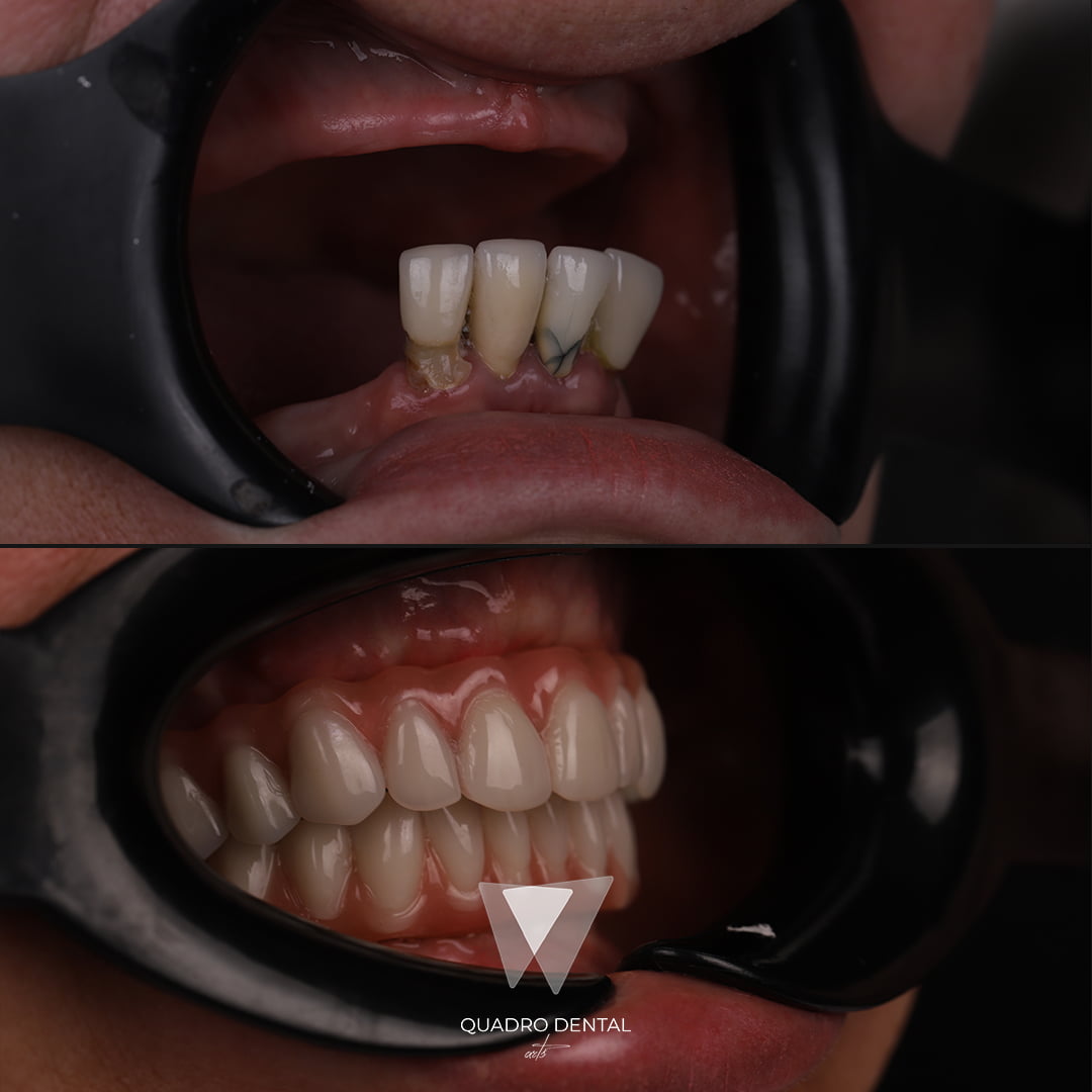 Quadro Dental patient before and after full dental restoration