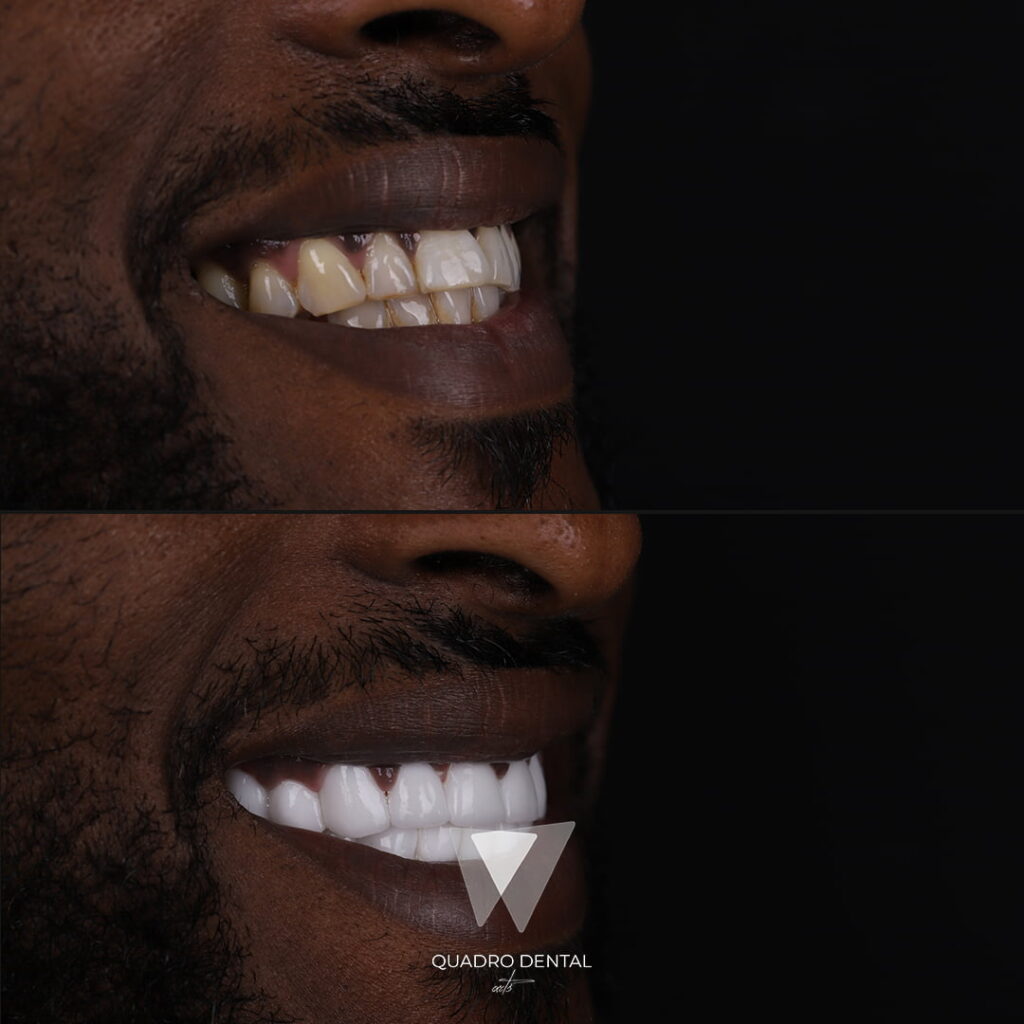 Quadro Dental patient before and after Hollywood Smile makeover in Turkey