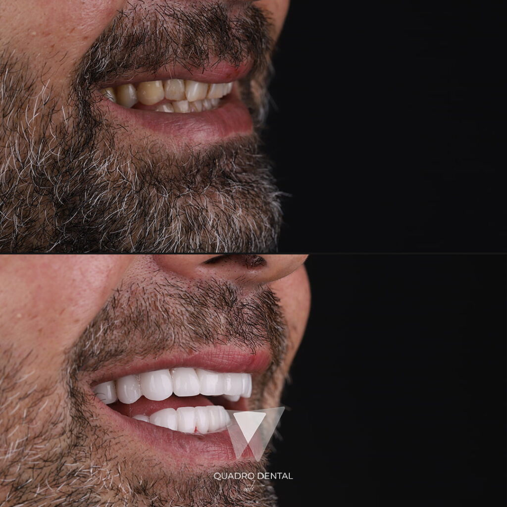 Quadro Dental patient before and after Hollywood Smile treatment in Turkey