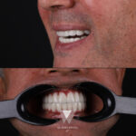 Quadro Dental patient after smile makeover treatment