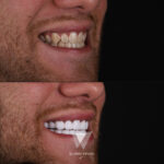 Quadro Dental patient before and after cosmetic dental procedure