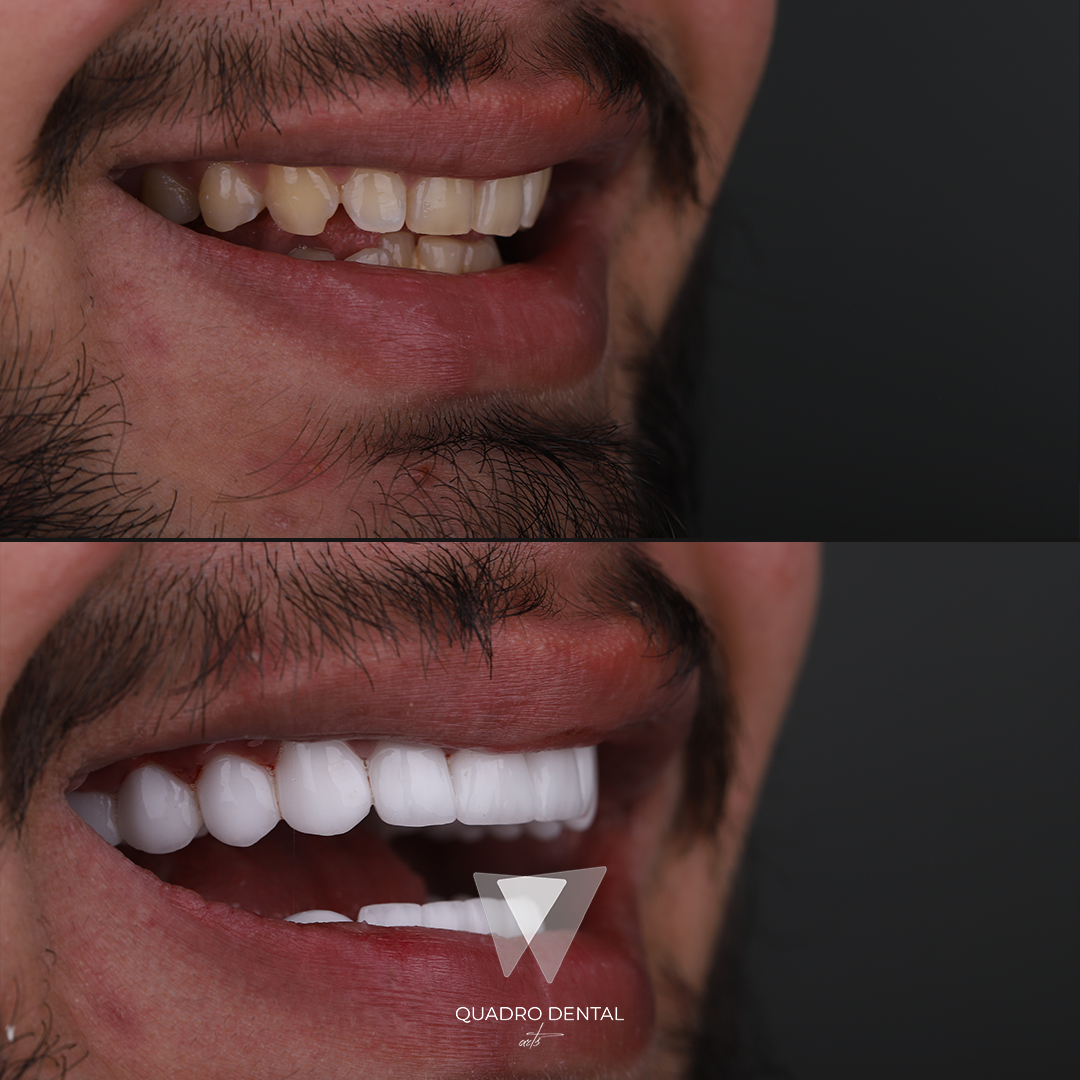 Quadro Dental patient before and after cosmetic dental treatment