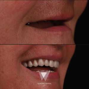 Quadro Dental patient before and after dental bridge treatment