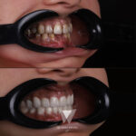 Quadro Dental patient before and after dental crowns treatment