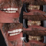 Quadro Dental patient before and after dental implant treatment