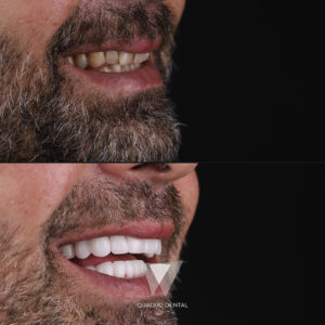 Quadro Dental patient before and after dental restoration treatment