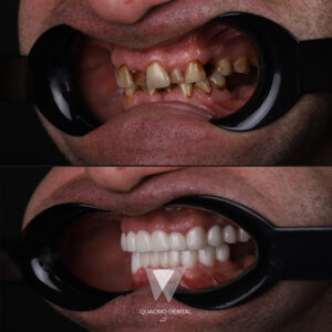 Quadro Dental patient before and after full mouth restoration