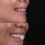 Quadro Dental patient before and after full smile restoration