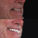 Quadro Dental patient before and after gum contouring treatment