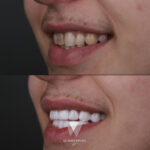 Quadro Dental patient before and after orthodontic treatment