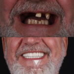 Quadro Dental patient before and after porcelain veneers treatment