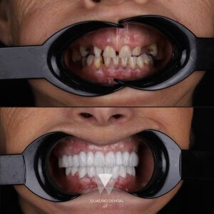 Quadro Dental patient before and after teeth straightening treatment