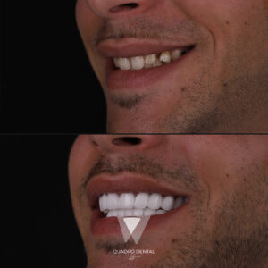 Quadro Dental patient before and after teeth whitening treatment