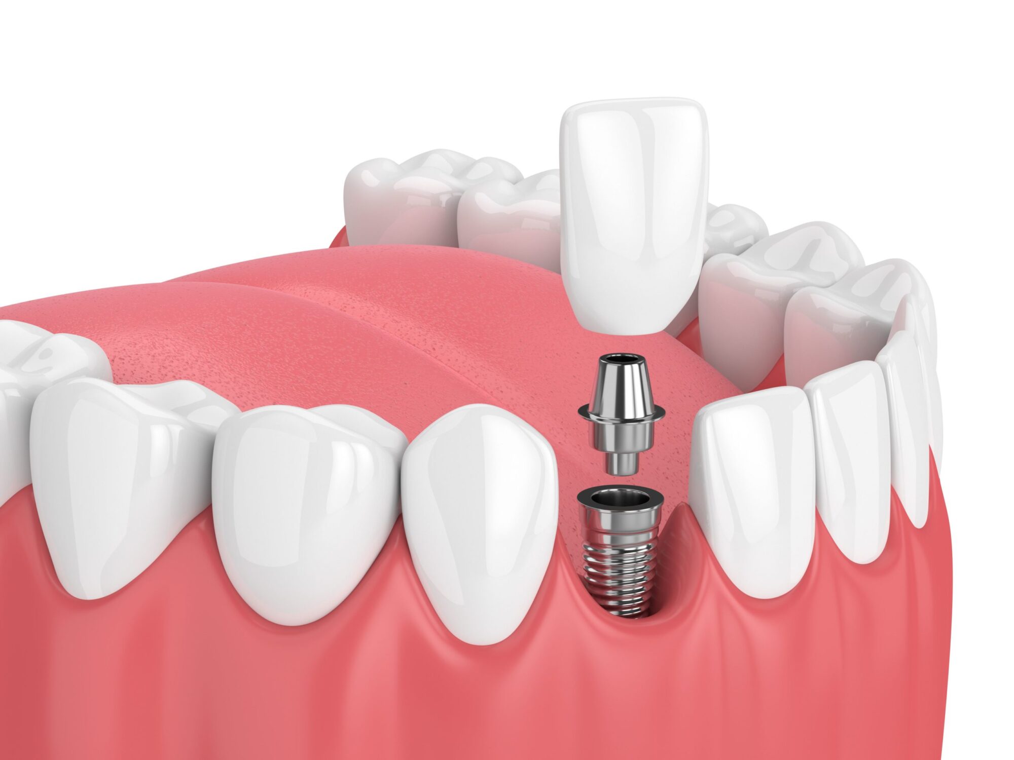 3D rendering of a dental implant being placed into a tooth