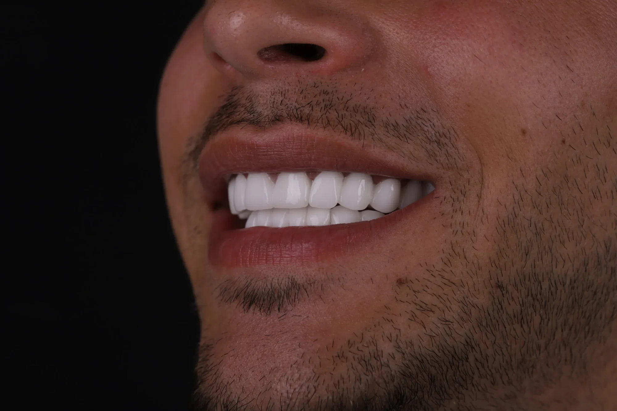 A patient smiling confidently after a successful dental treatment at Quadro Dental, showcasing the results in before-and-after videos.