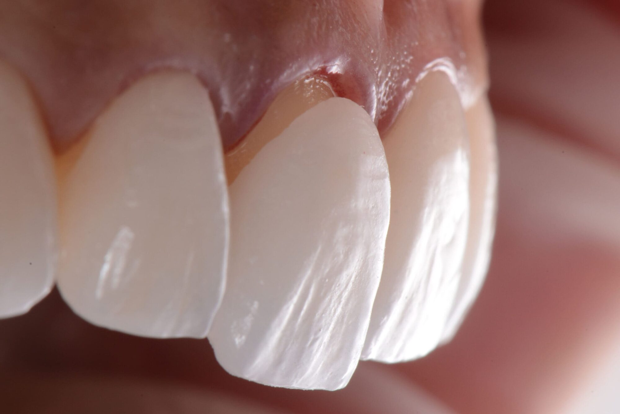 Laminate veneers treatment in Turkey for Turkey teeth at Quadro Dental