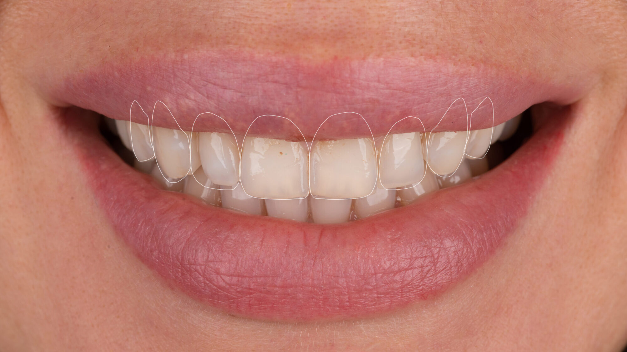 Smile makeover treatment at Quadro Dental in Turkey