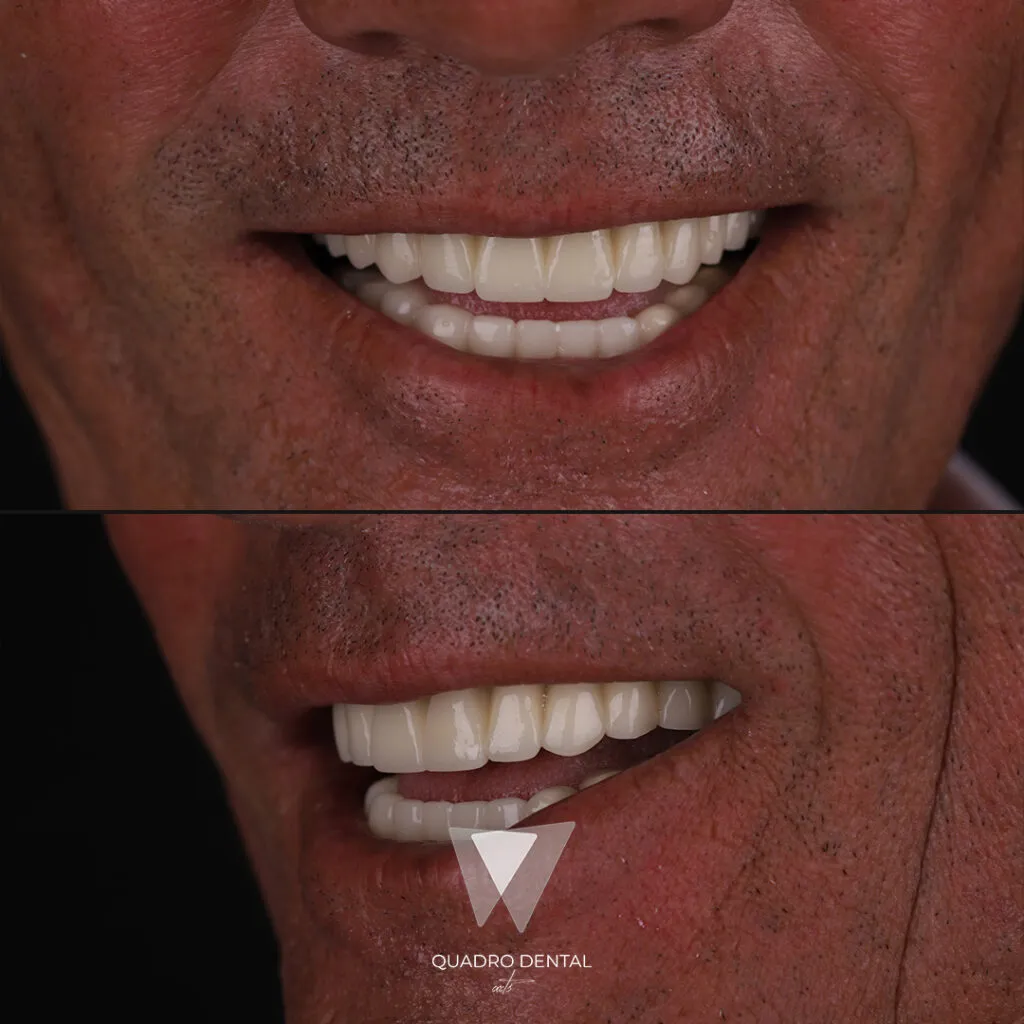 After dental treatment results at Quadro Dental, showcasing perfect smile restoration as a Helvetic Clinics alternative.