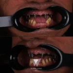 After dental treatment results at Quadro Dental, showcasing perfect smile restoration as a Helvetic Clinics alternative.