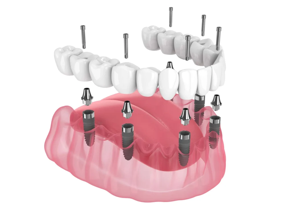 A 3D illustration of All-on-6 dental implants, showing the advanced structure for full-arch restoration used in dental implants abroad, including Helvetic clinics and Quadro Dental.