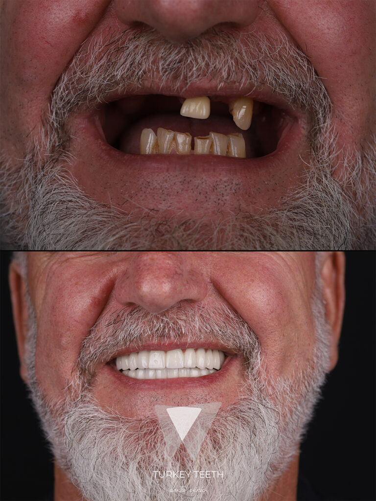 Dental implants in Turkey – Permanent tooth replacement solutions by Turkey Teeth experts.