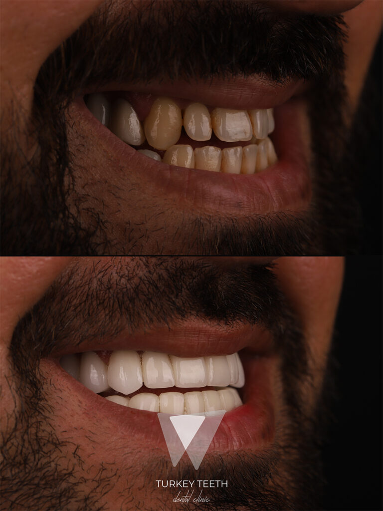 Hollywood Smile transformation in Turkey – A bright, natural-looking smile with Quadro Dental expertise.