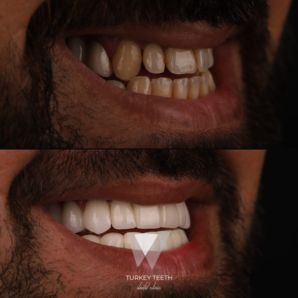 Before and after results of a Hollywood Smile treatment at Quadro Dental, showcasing a remarkable transformation with high-quality dental veneers.
