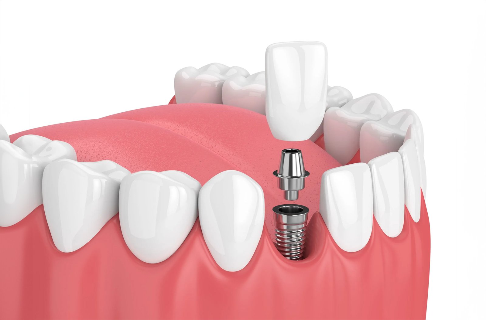 High-quality dental implants in Turkey – Permanent tooth replacement solution