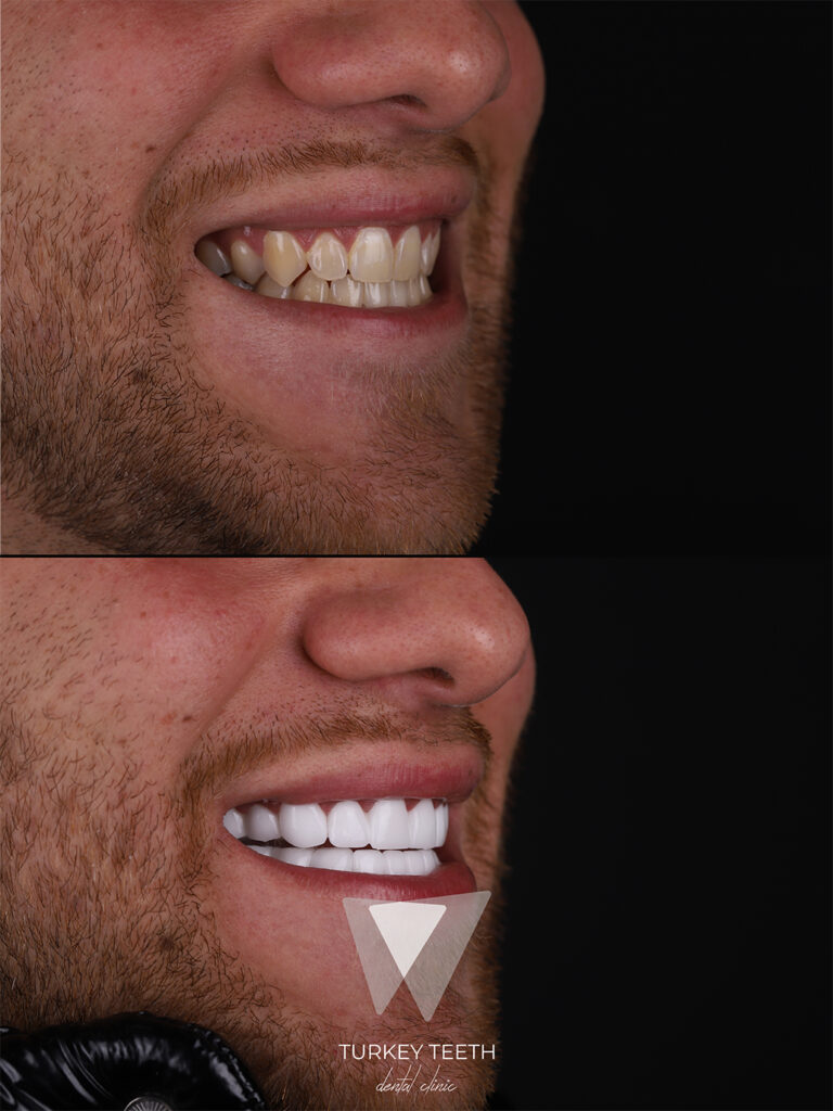 Zirconium Crowns in Turkey – Strong, natural-looking dental crowns by Quadro Dental.