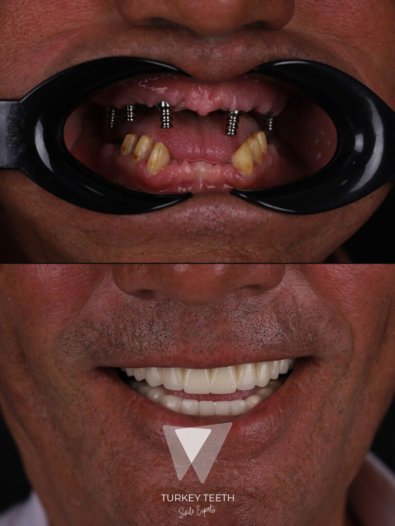 Before and after All-on-6 dental implants in Turkey showing a full arch fixed smile restoration