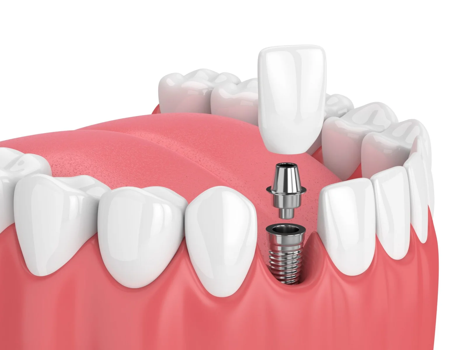 3D illustration of a dental implant procedure showing implant screw, abutment, and crown in Turkey