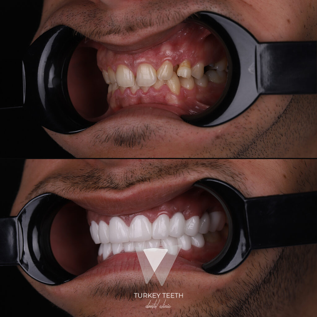 Before and after Hollywood Smile transformation in Turkey with aligned and whitened teeth