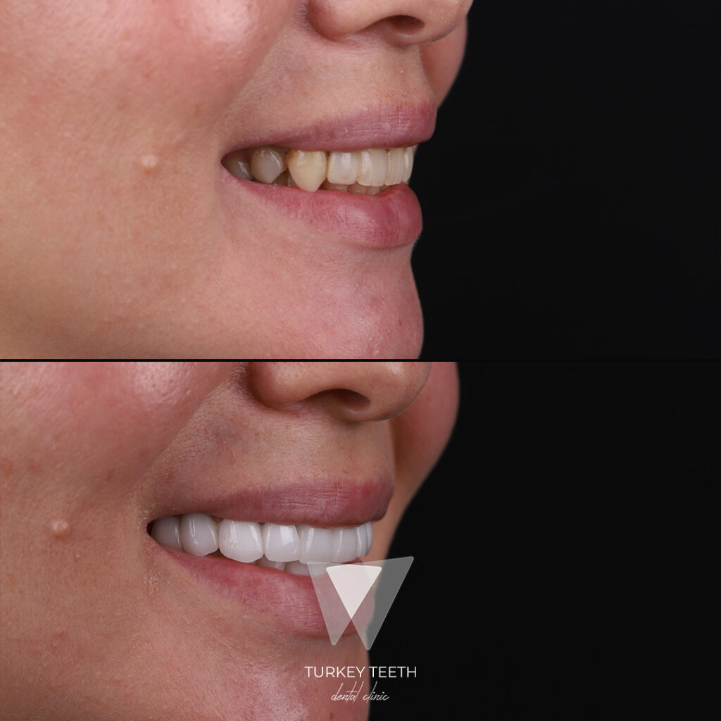 Before and after side view of smile makeover treatment in Turkey showing full upper arch transformation