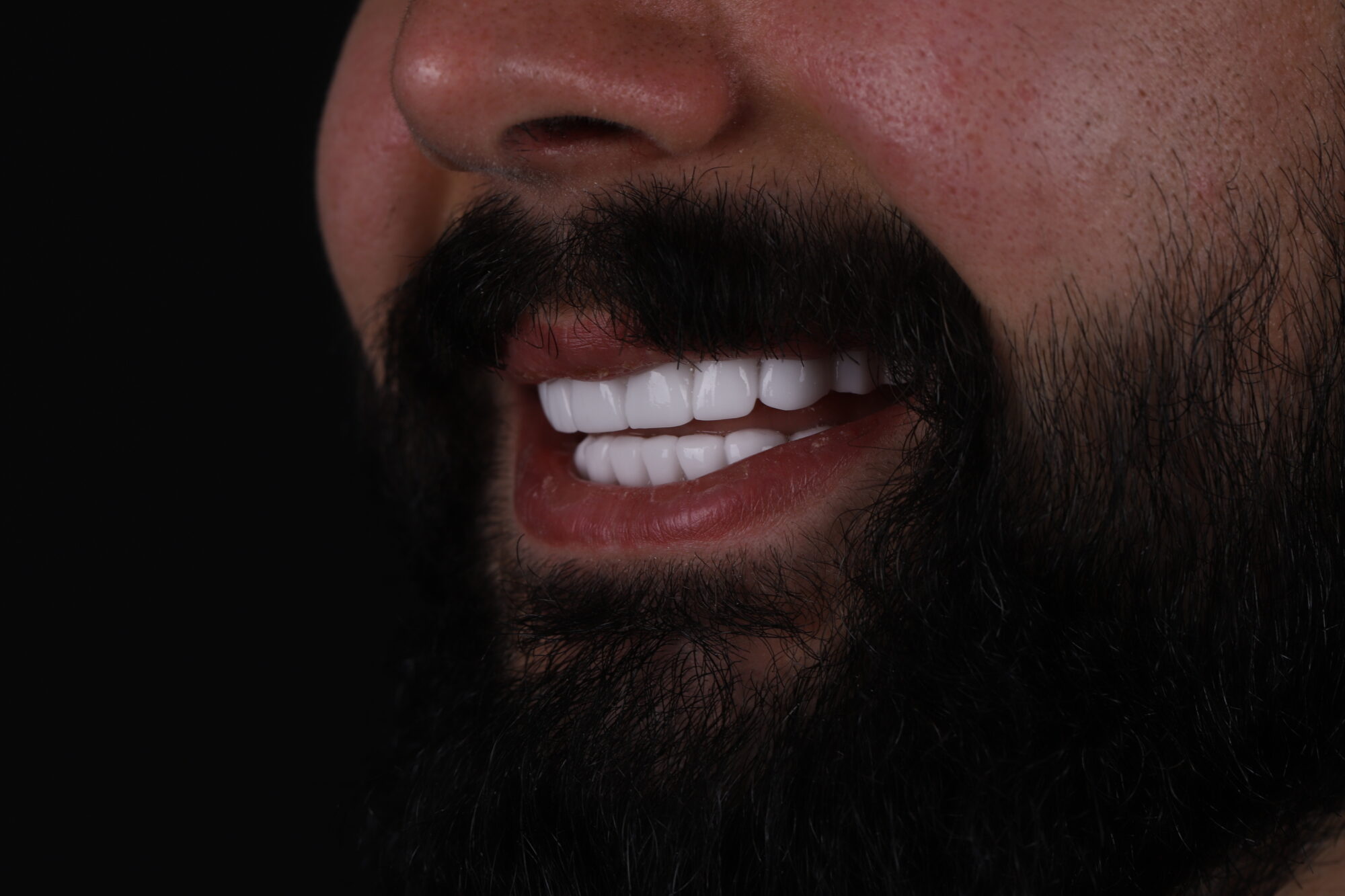Before and after Quadro Dental transformations in Antalya