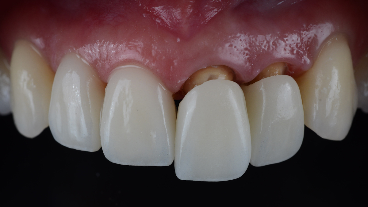 Close-up view of zirconium crowns placed on upper front teeth in Turkey