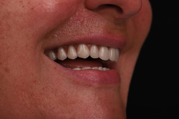Final side view of smile after All-on-4 implants in Turkey