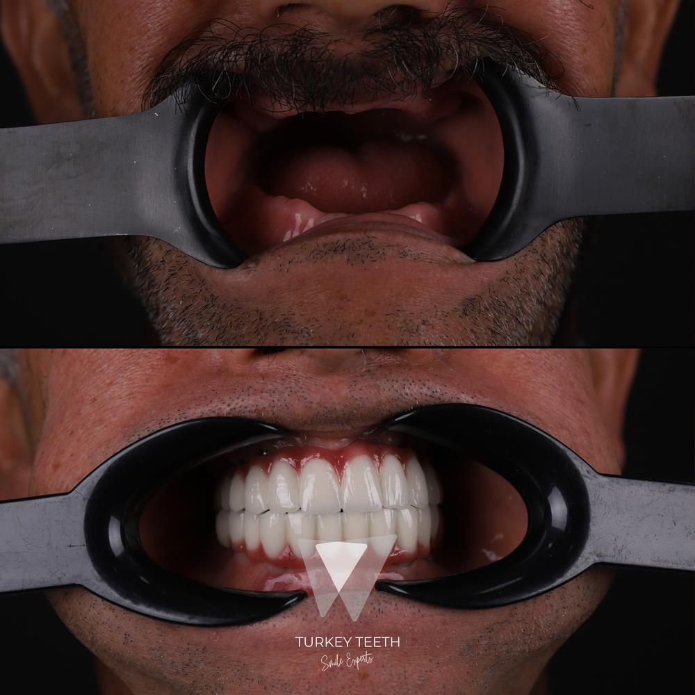 Before and after All-on-6 treatment in a toothless case