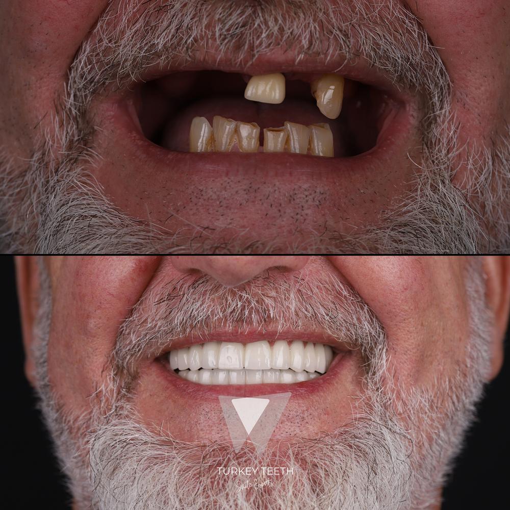 Before and after of a full smile makeover with All-on-6 dental implants