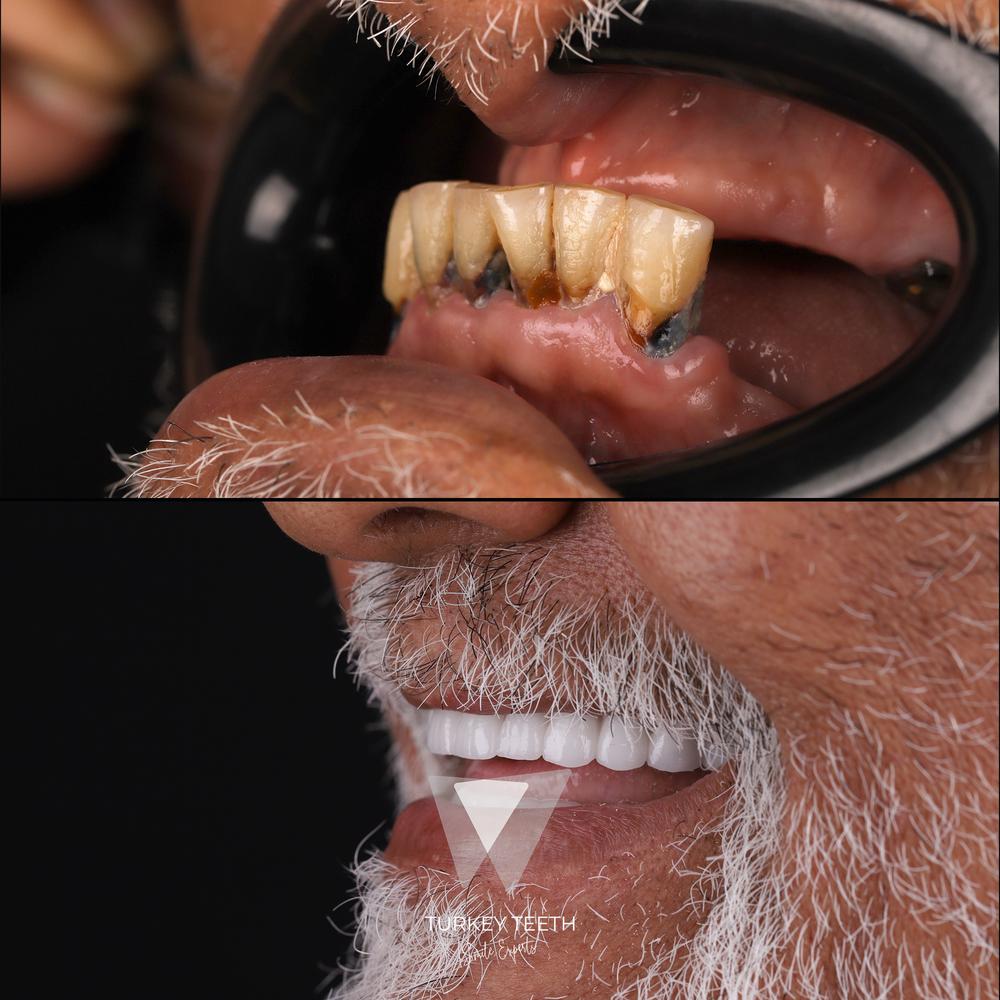 Before and after result of All-on-6 dental implants for full mouth restoration