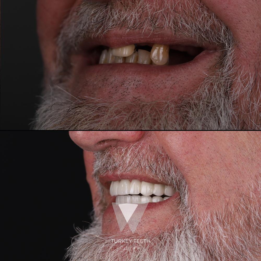 Profile before and after All-on-6 smile restoration