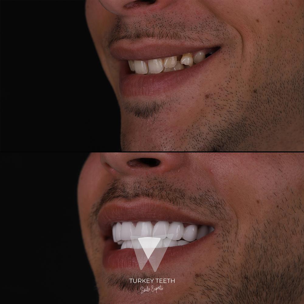 Front view before and after smile makeover of chipped teeth patient