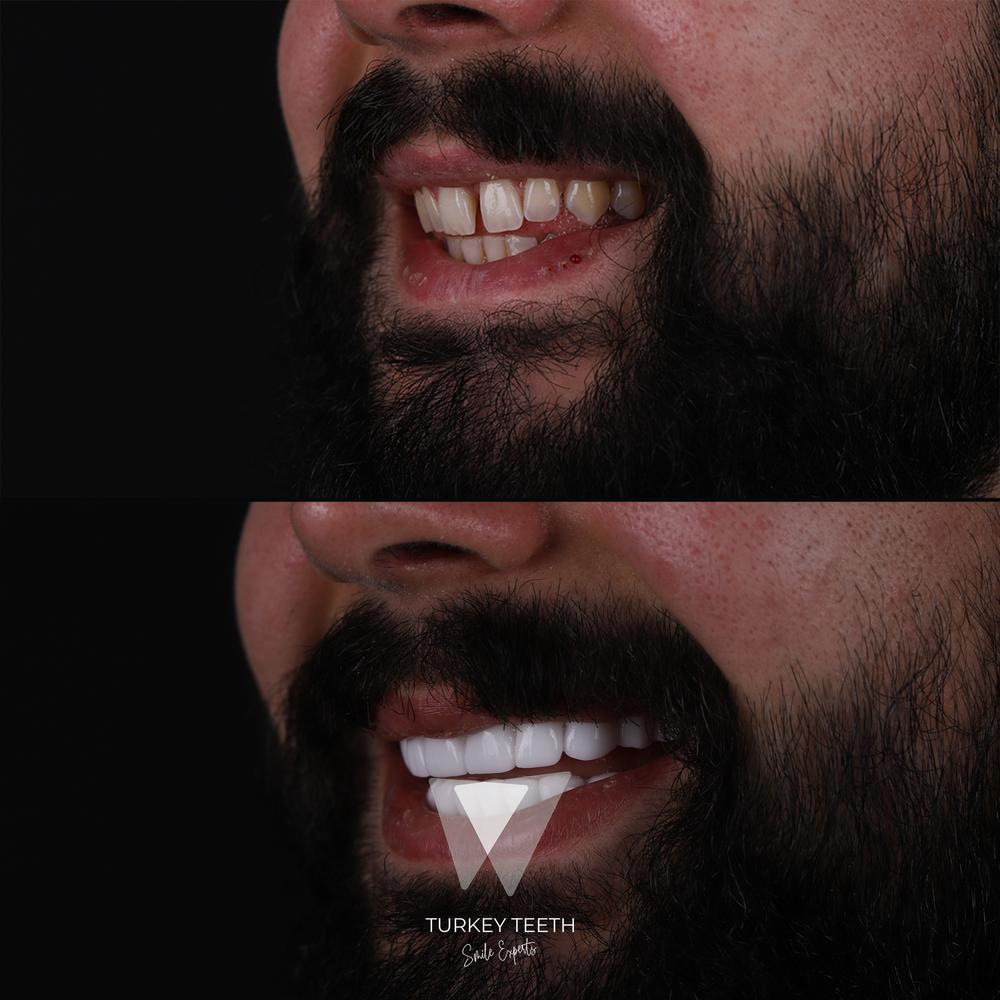 Before and after images of chipped and missing teeth restoration with Hollywood Smile