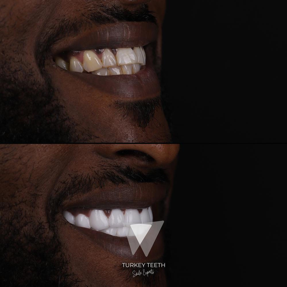 Before and after photo of Hollywood Smile procedure for discolored and uneven teeth