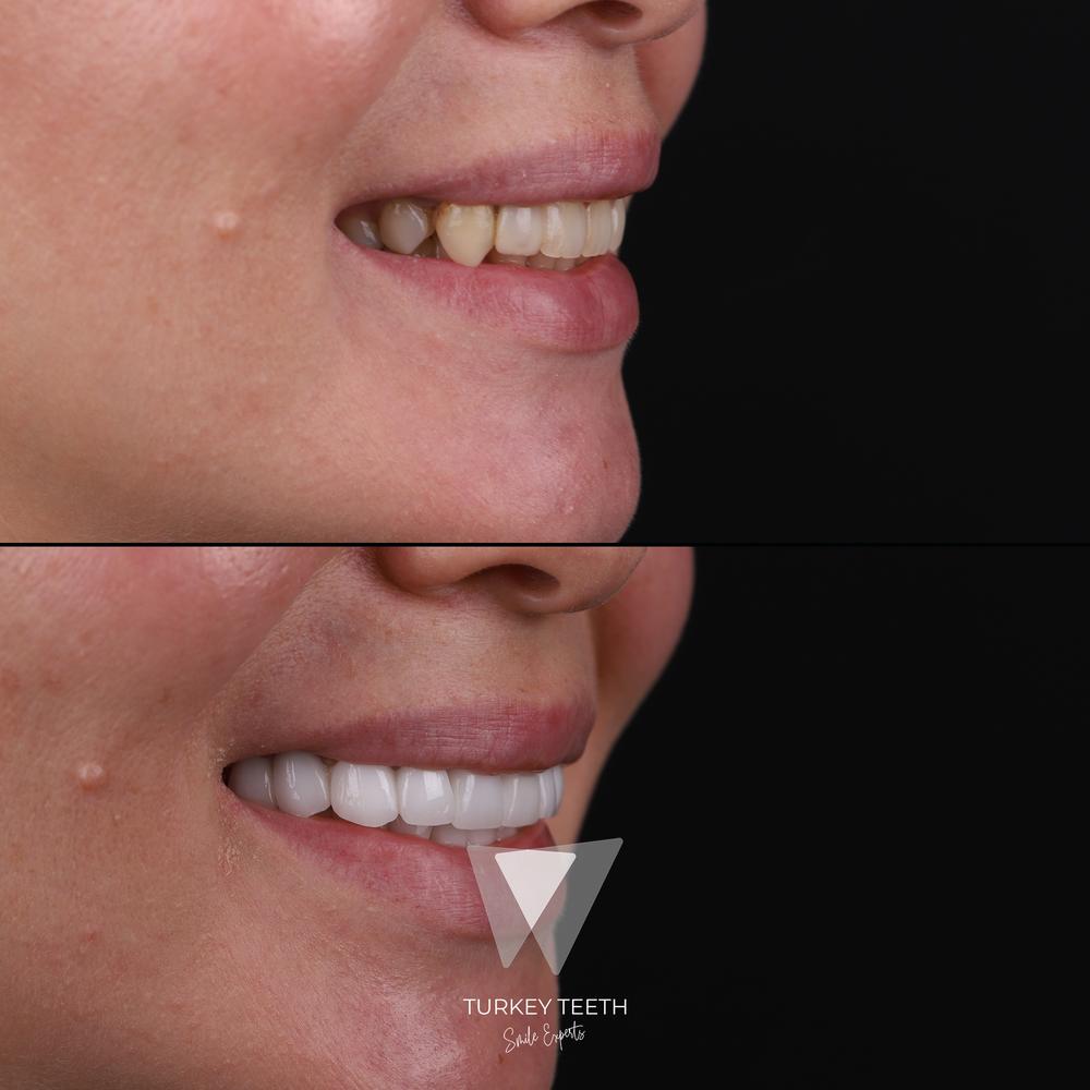 Before and after of smile design treatment for discoloration and alignment