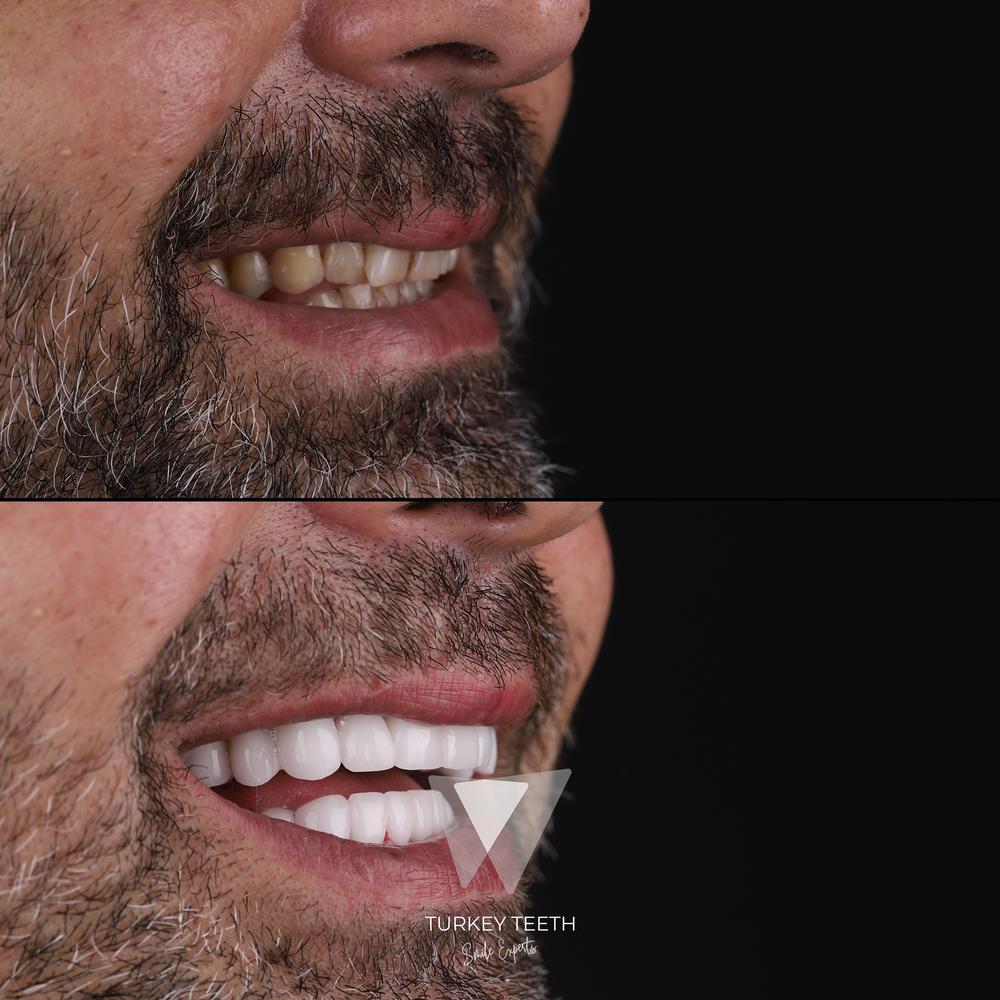 Before and after comparison of smile makeover for discolored teeth – side view