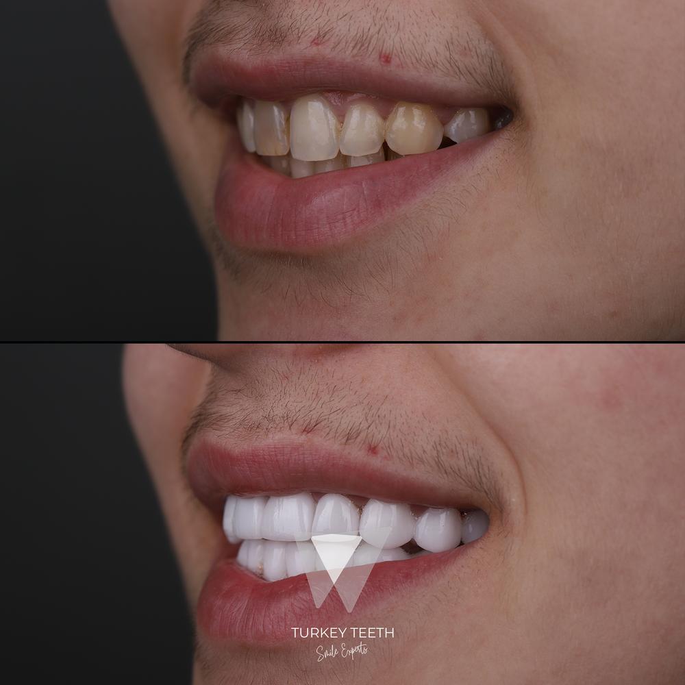 Before and after of smile makeover for enamel defects – Turkey case
