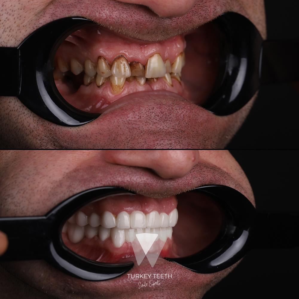 Before and after of full mouth dental restoration with fixed crowns