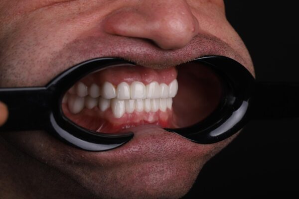 Final smile after full mouth fixed dental restoration in Turkey
